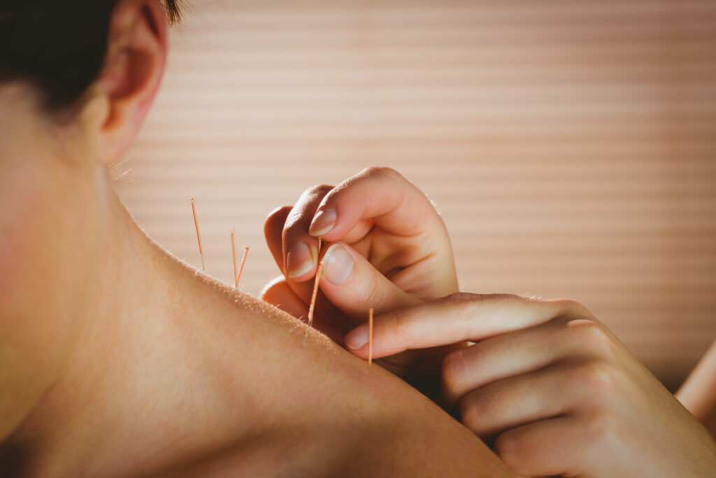 Dry needling of neck in Victoria, BC