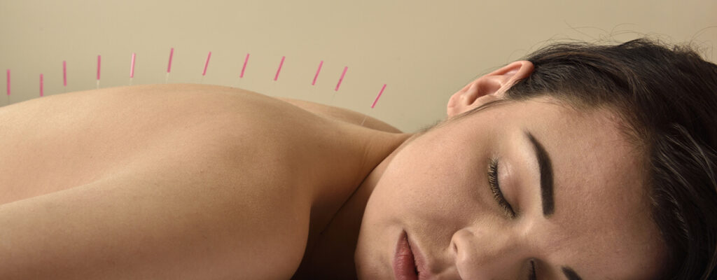 Benefits of Acupuncture