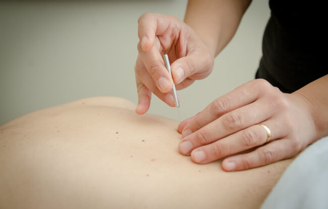 Benefits of Acupuncture
