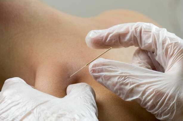 Acupuncture