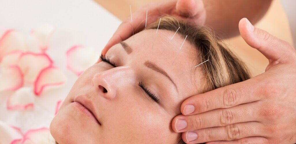 Acupuncture