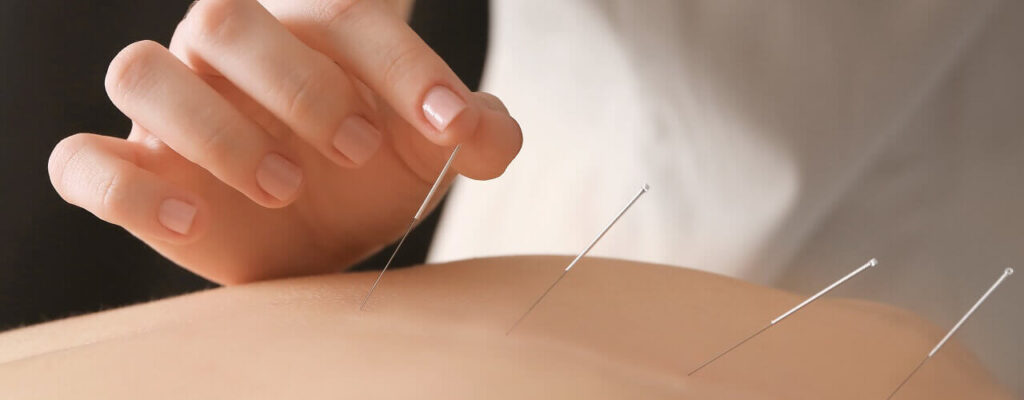 Acupuncture