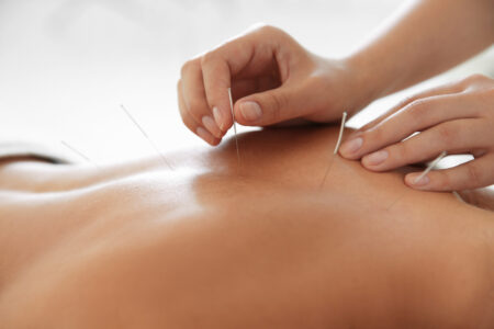 Dry needling, back.